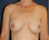 Feel Beautiful - Breast Revision with Augmentation 410 - Before Photo
